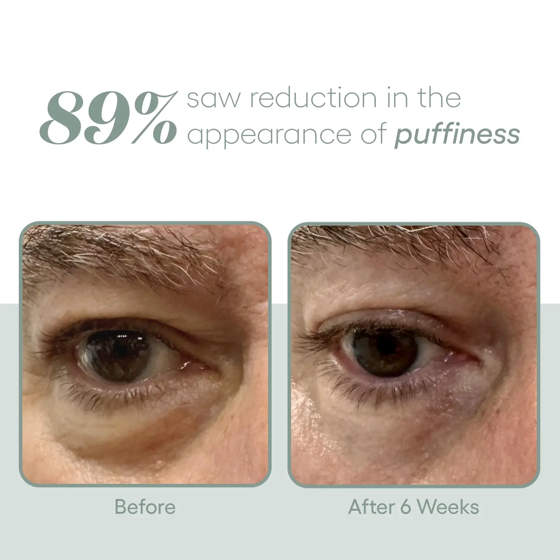 Exosome EYE Serum before and after photos