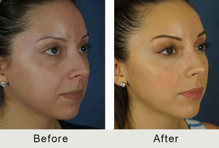 before and after ethnic rhinoplasty non surgical