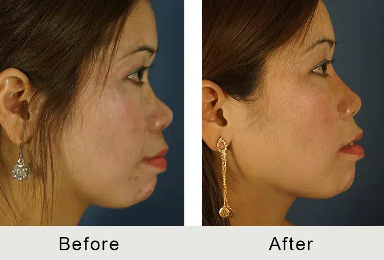before and after non surgical rhinoplasty