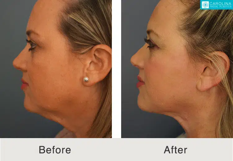 real patient results following facelift for fine lines, wrinkles, and sagging lower skin in charlotte