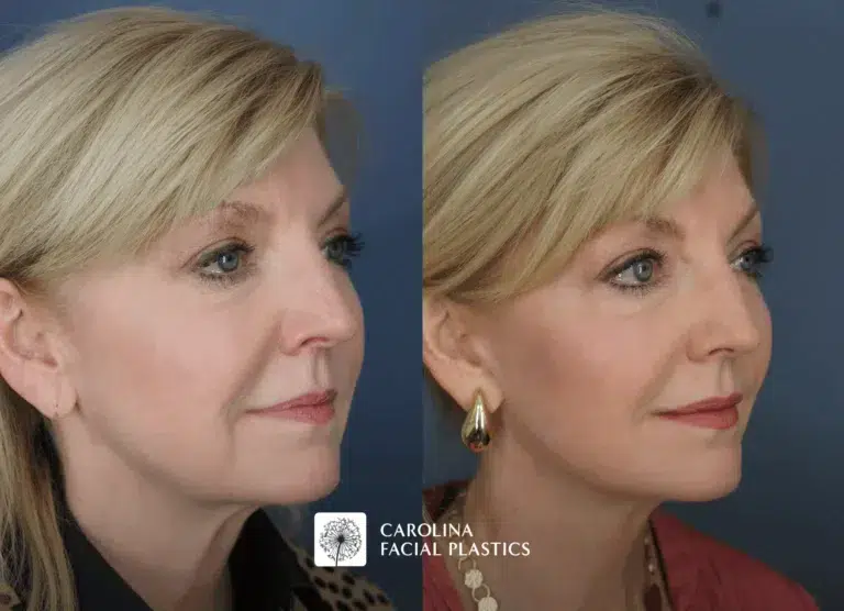 before and after mini facelift to treat fine lines and wrinkles in Charlotte