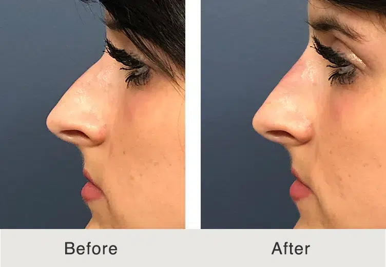before and after nose rhinoplasty non surgical