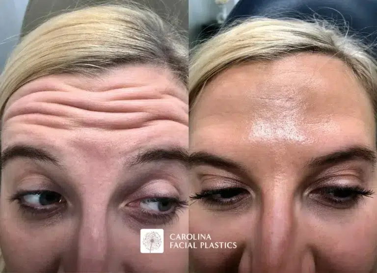 before and after fine lines and wrinkle treatment in charlotte
