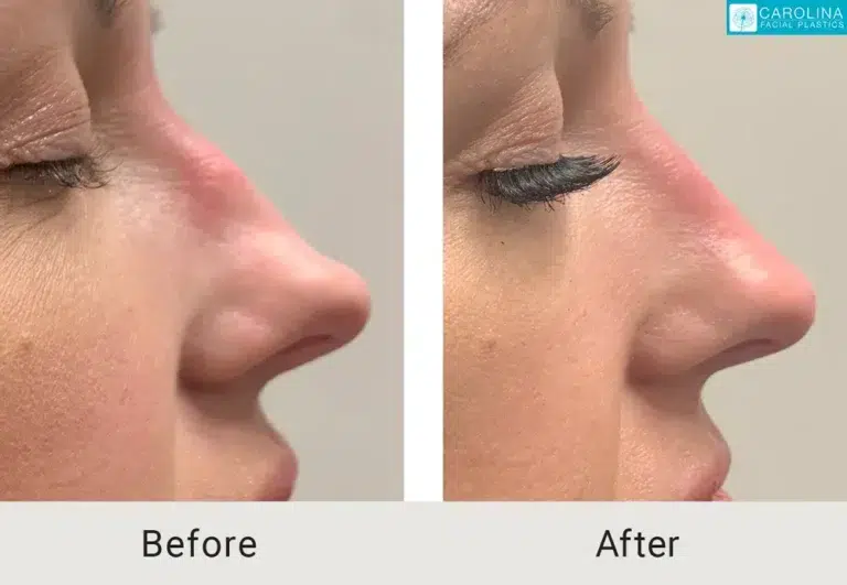 non surgical rhinoplasty before and after