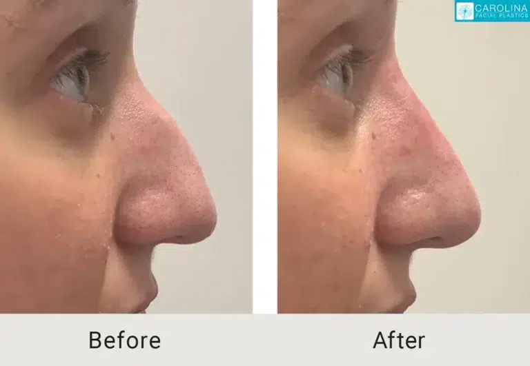 before and after non surgical rhinoplasty