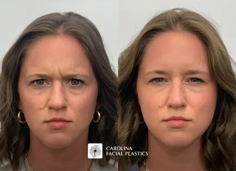 Female patient before and after treatment for fine lines and wrinkles in Charlotte