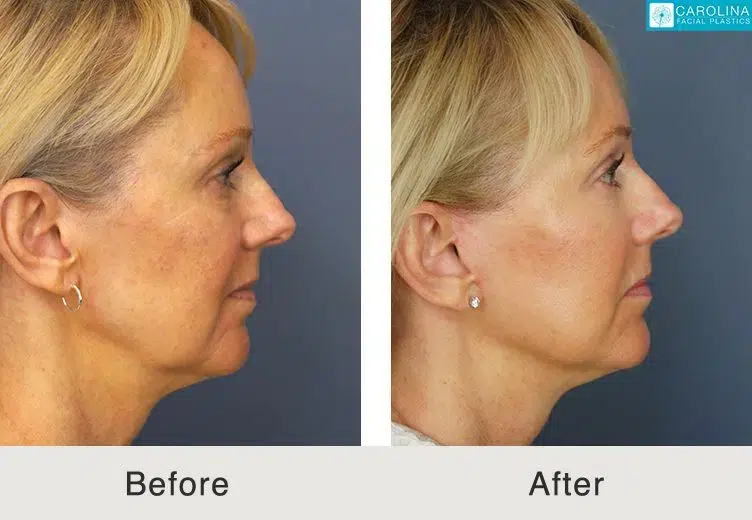 before and after mini facelift for wrinkles and fine lines in charlotte