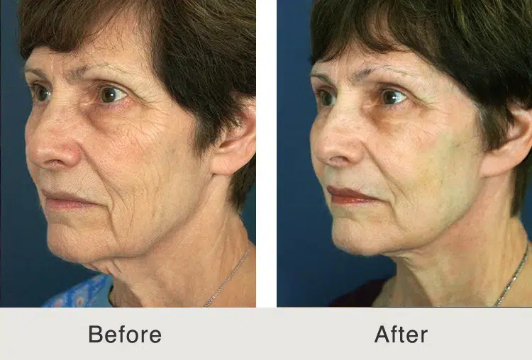before and after facelift and lower blepharoplasty to treat fine lines and wrinkles in charlotte