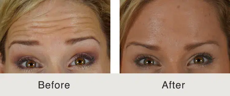 before and after botox on forehead to treat fine lines and wrinkles in charlotte