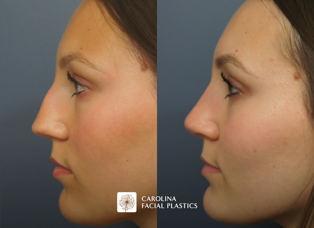 Septorhinoplasty by Dr Jonathan Kulbersh