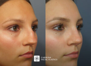 Oblique view of female patient's nose following Septorhinoplasty in charlotte