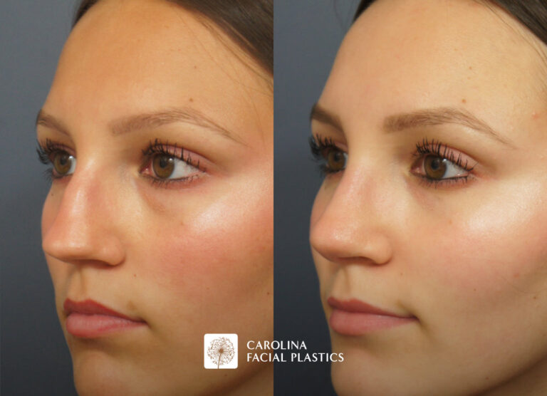 Septorhinoplasty by Dr Jonathan Kulbersh