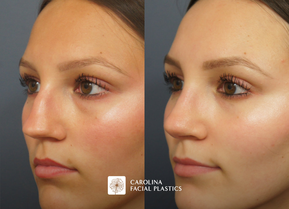 Septorhinoplasty by Dr Jonathan Kulbersh