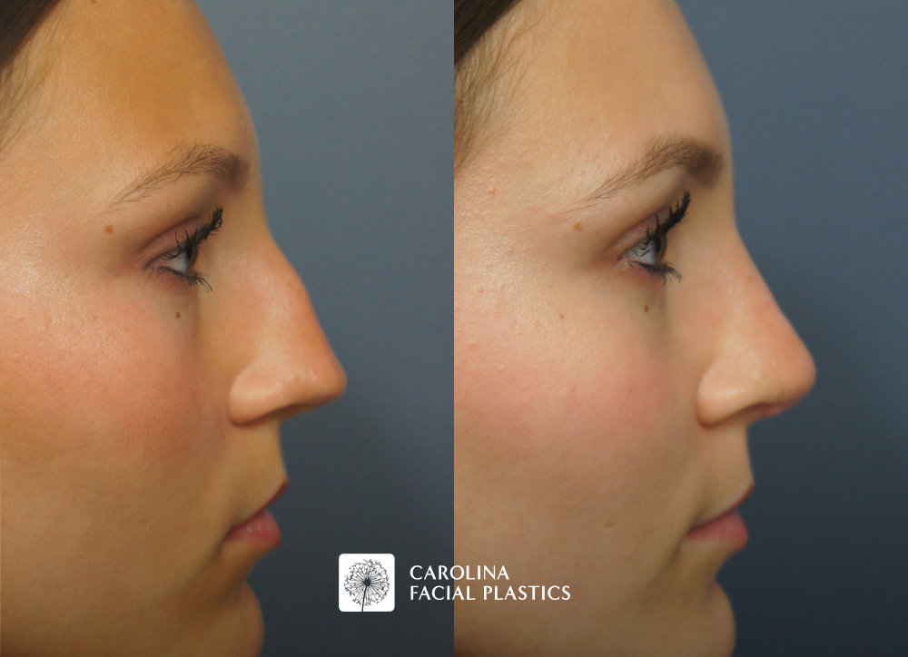 Septorhinoplasty by Dr Jonathan Kulbersh