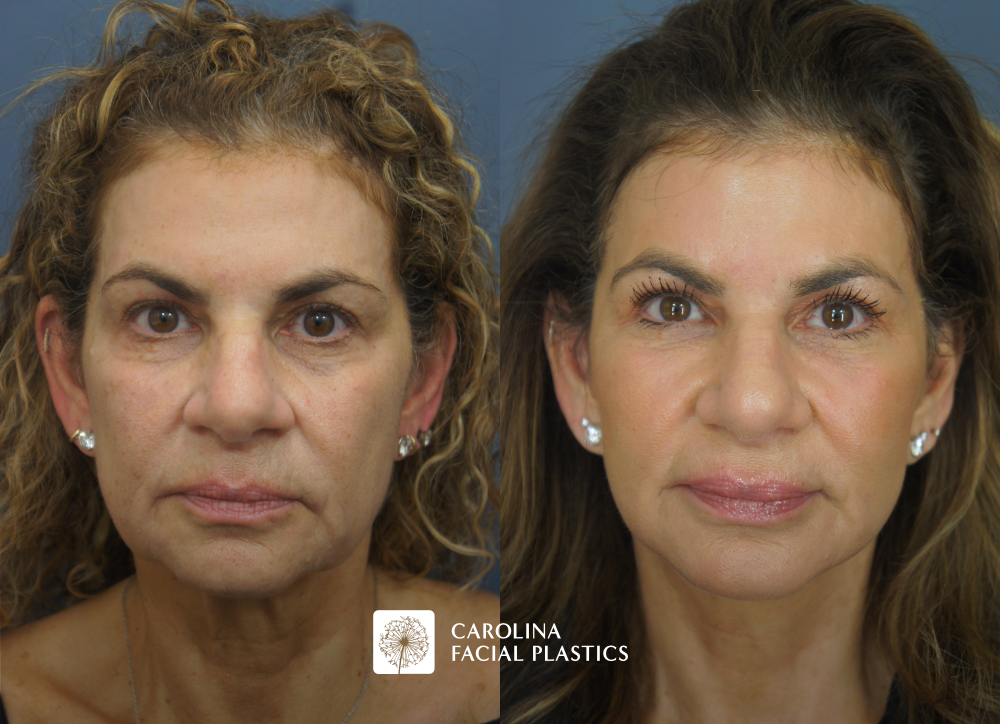 Facelift, Buccal Fat Reduction, Fat Grafting of the Lower Eyes and Chin, and TCA Peel by Dr Jonathan Kulbersh