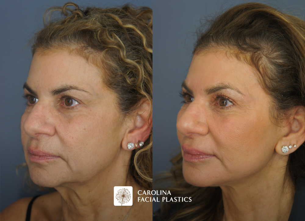 Facelift, Buccal Fat Reduction, Fat Grafting of the Lower Eyes and Chin, and TCA Peel by Dr Jonathan Kulbersh