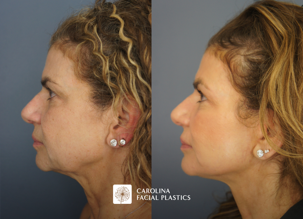 Facelift, Buccal Fat Reduction, Fat Grafting of the Lower Eyes and Chin, and TCA Peel by Dr Jonathan Kulbersh