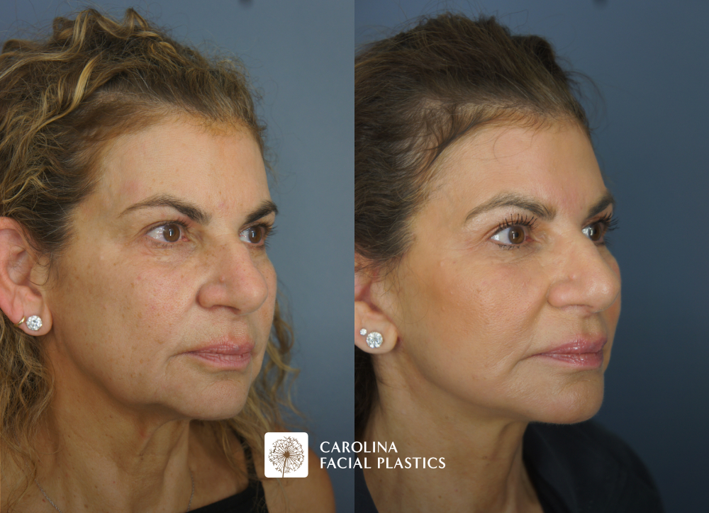 Facelift, Buccal Fat Reduction, Fat Grafting of the Lower Eyes and Chin, and TCA Peel by Dr Jonathan Kulbersh