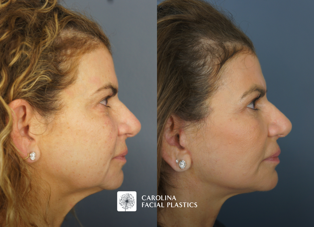 Facelift, Buccal Fat Reduction, Fat Grafting of the Lower Eyes and Chin, and TCA Peel by Dr Jonathan Kulbersh