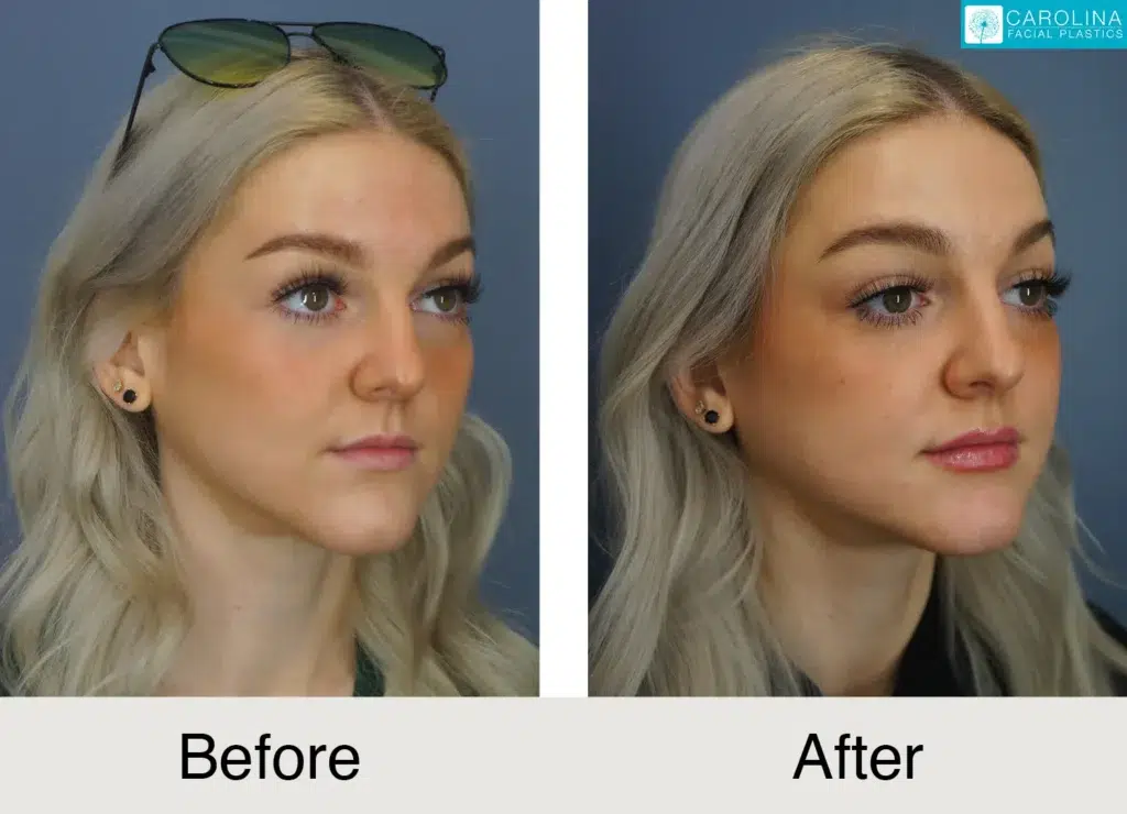 before and after lip filler