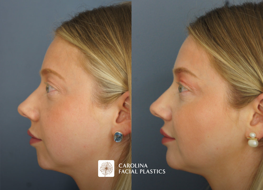 Carolina Facial Plastics - Chin Implant before and after, angle 2
