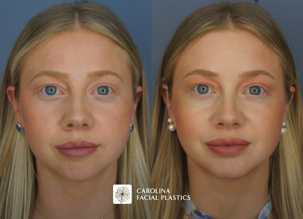 Carolina Facial Plastics - Chin Implant before and after, angle 5