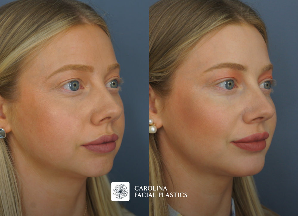 Carolina Facial Plastics - Chin Implant before and after, angle 4