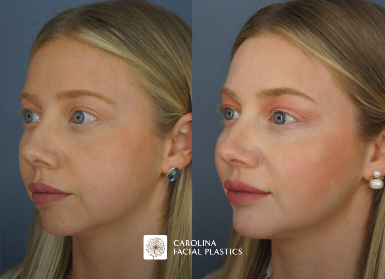 Carolina Facial Plastics - Chin Implant before and after, angle 1