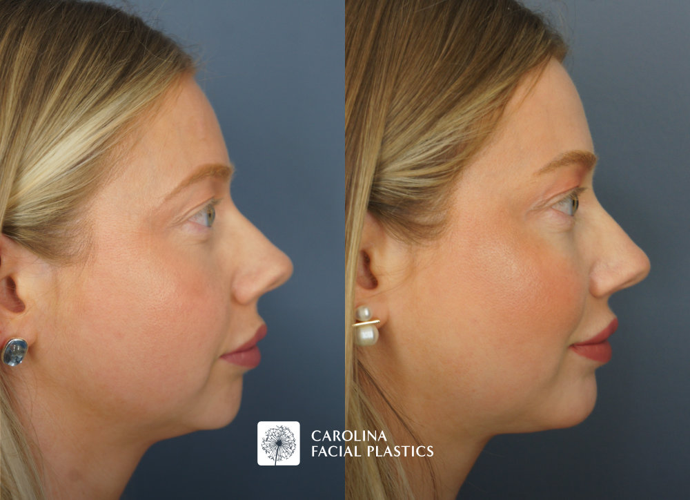 Carolina Facial Plastics - Chin Implant before and after, angle 3