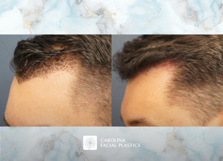 Carolina Facial Plastics - Hair Transplant before and after