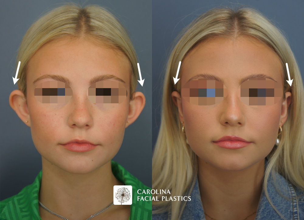 Carolina Facial Plastics - Otoplasty before and after, angle 5