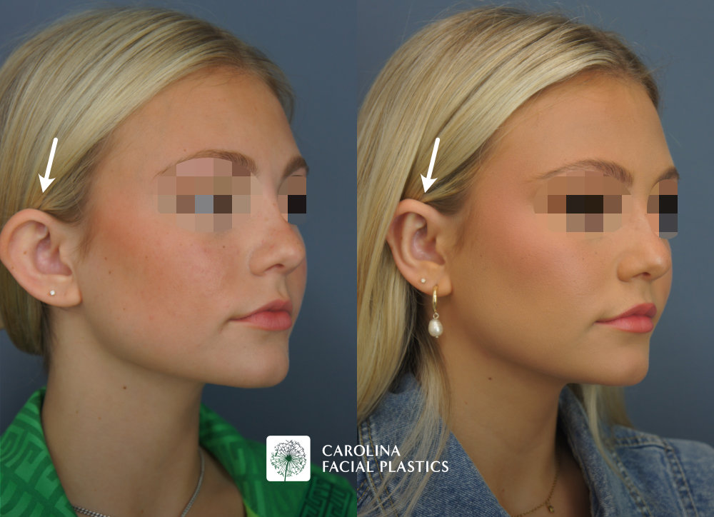 Carolina Facial Plastics - Otoplasty before and after, angle 4