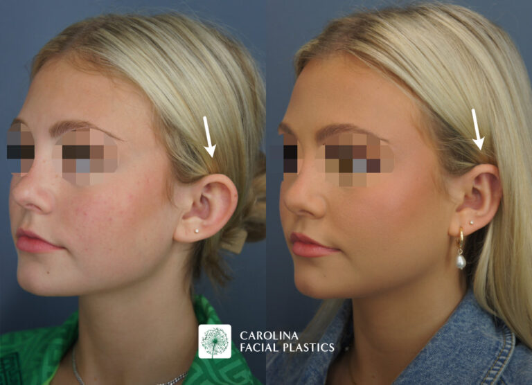 Carolina Facial Plastics - Otoplasty before and after, angle 1