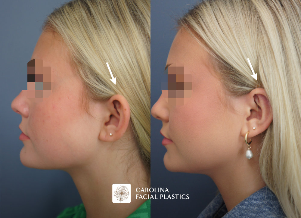 Carolina Facial Plastics - Otoplasty before and after, angle 2