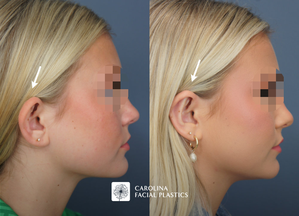 Carolina Facial Plastics - Otoplasty before and after, angle 3