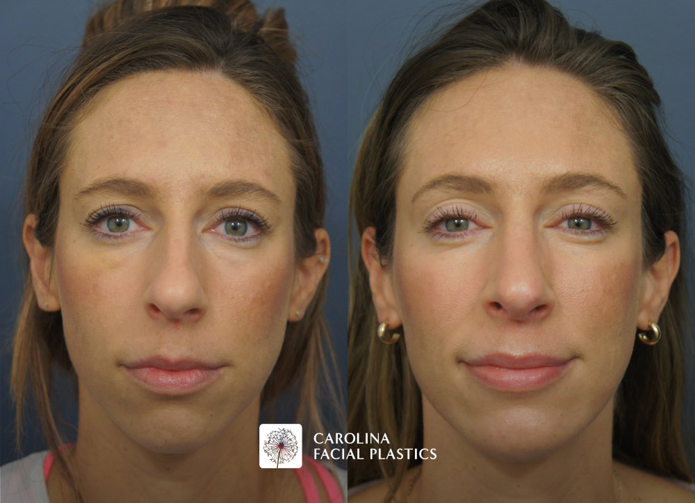 Carolina Facial Plastics - Rhinoplasty and Chin Implant before and after, angle 3