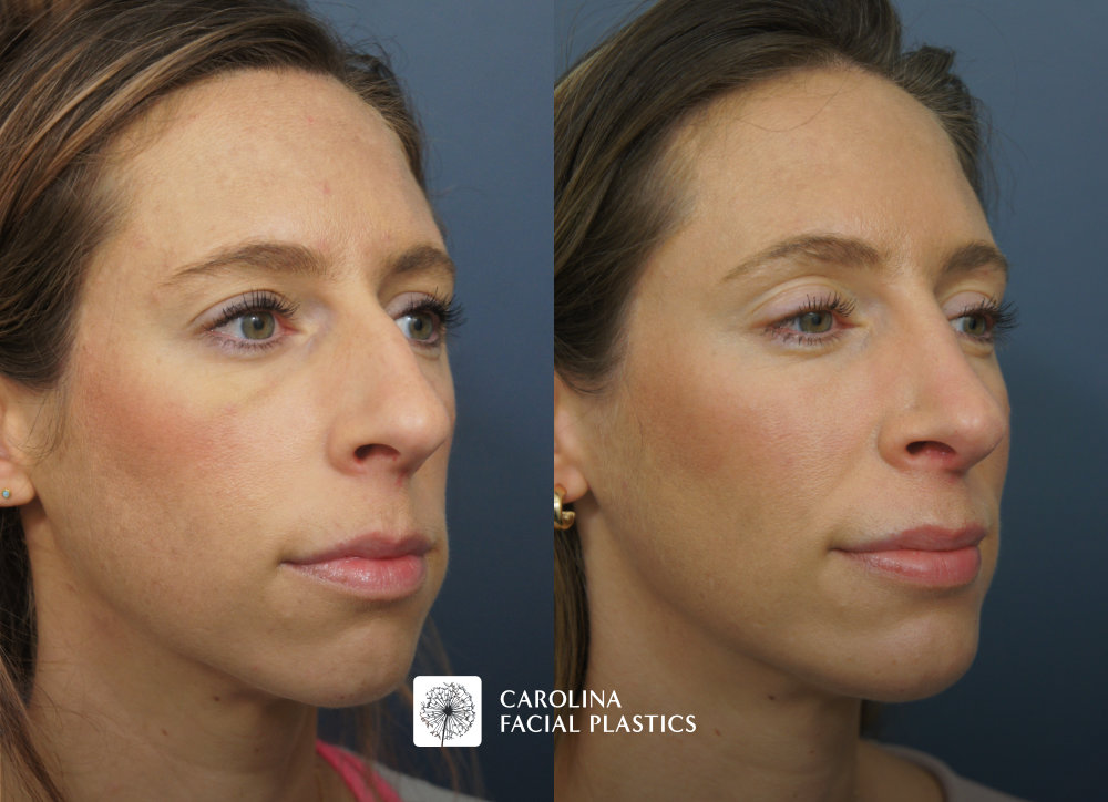 Carolina Facial Plastics - Rhinoplasty and Chin Implant before and after, angle 2