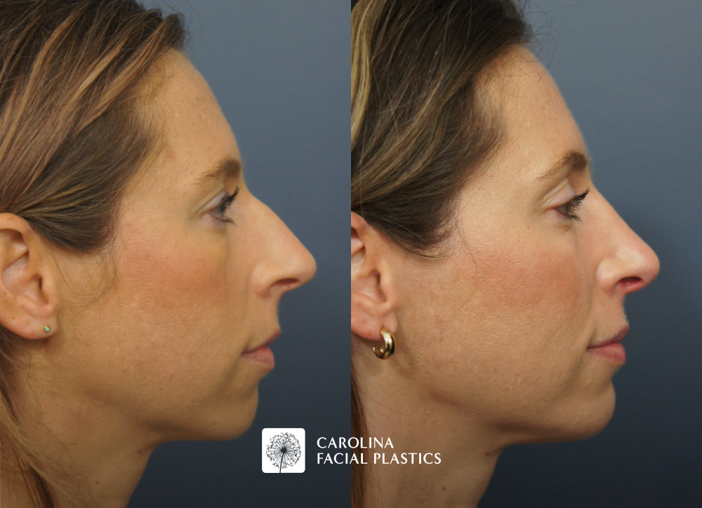 Carolina Facial Plastics - Rhinoplasty and Chin Implant before and after, angle 1