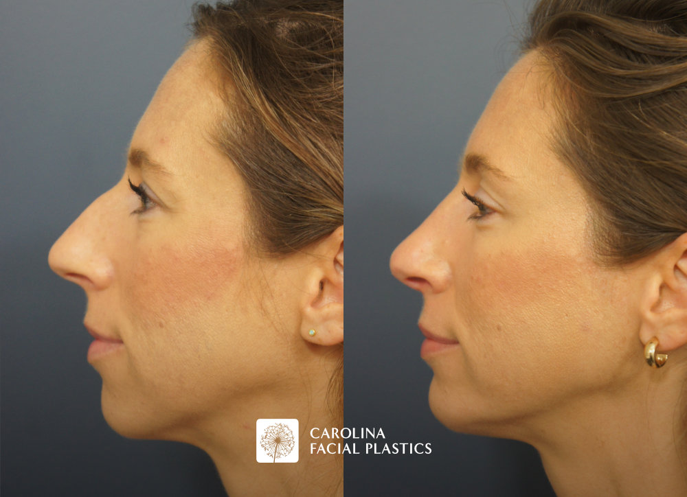 Carolina Facial Plastics - Rhinoplasty and Chin Implant before and after, angle 5