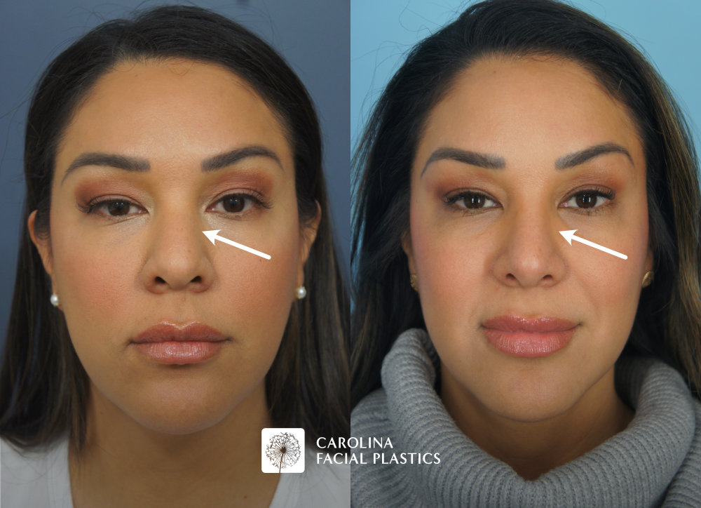 Carolina Facial Plastics - Rhinoplasty before and after, angle 3