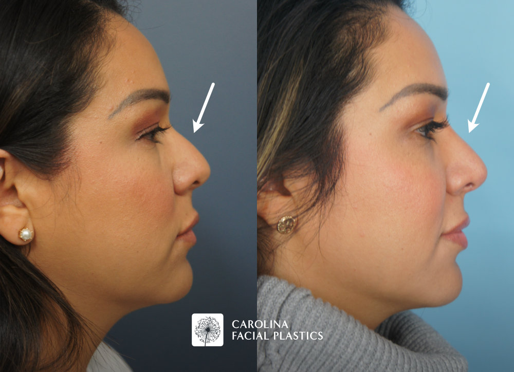 Carolina Facial Plastics - Rhinoplasty before and after, angle 1