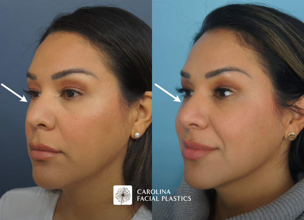 Carolina Facial Plastics - Rhinoplasty before and after, angle 4