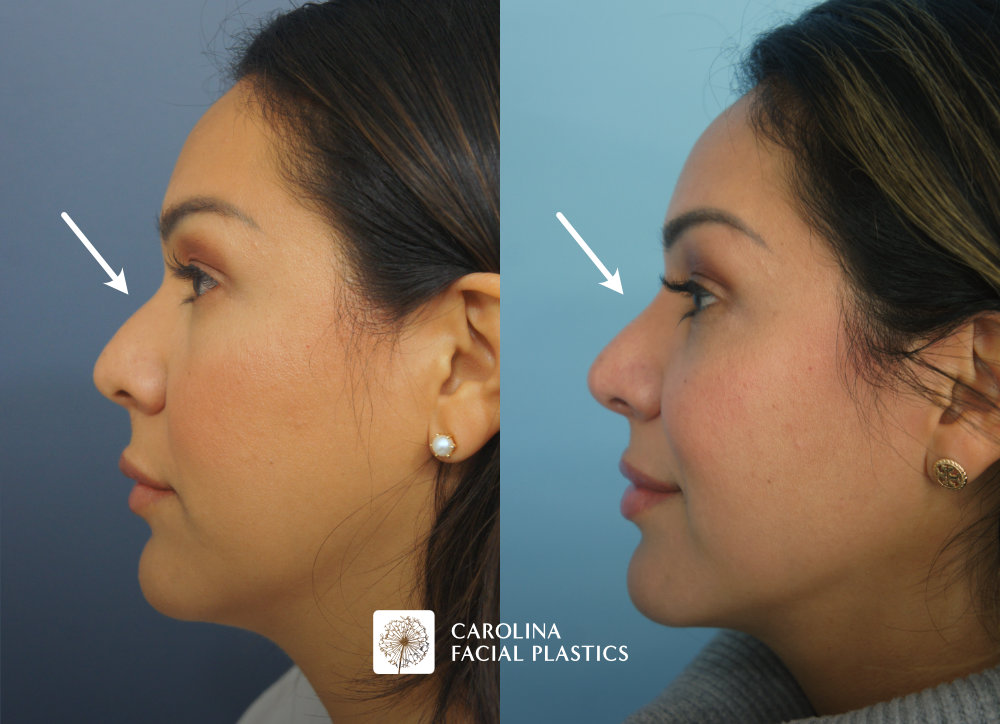 Carolina Facial Plastics - Rhinoplasty before and after, angle 5
