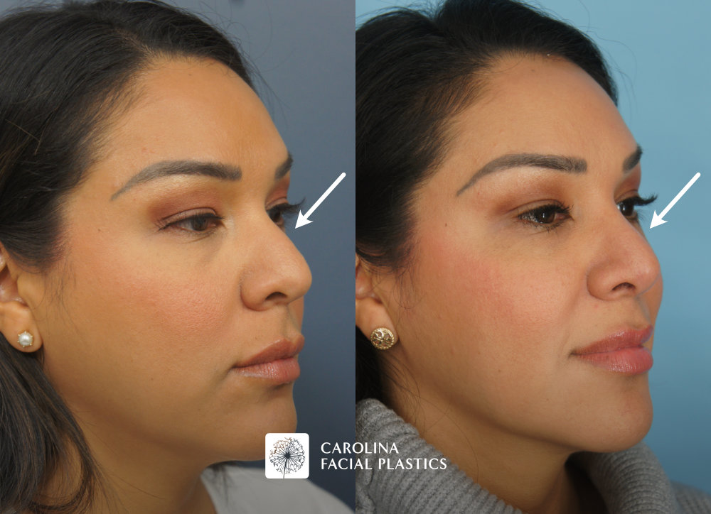 Carolina Facial Plastics - Rhinoplasty before and after, angle 2