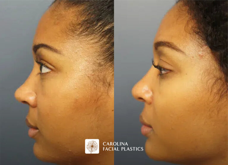 before and after ethnic rhinoplasty