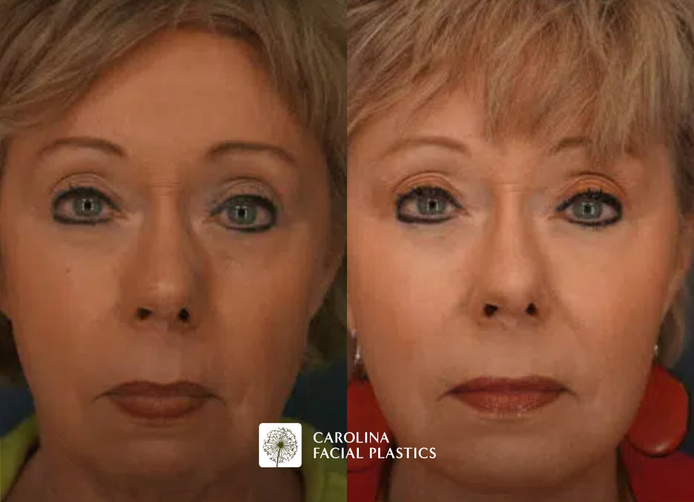 facial fat transfer in charlotte