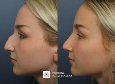 Side view of female patient before and after rhinoplasty in charlotte