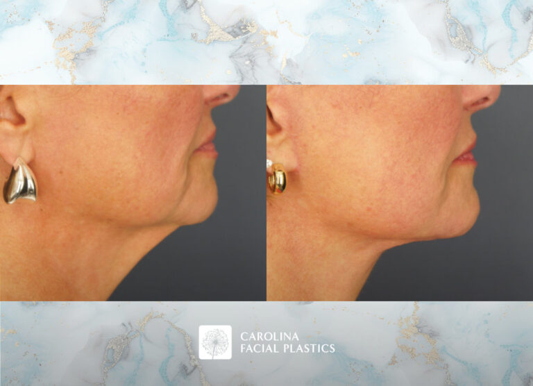 before and after facelift image