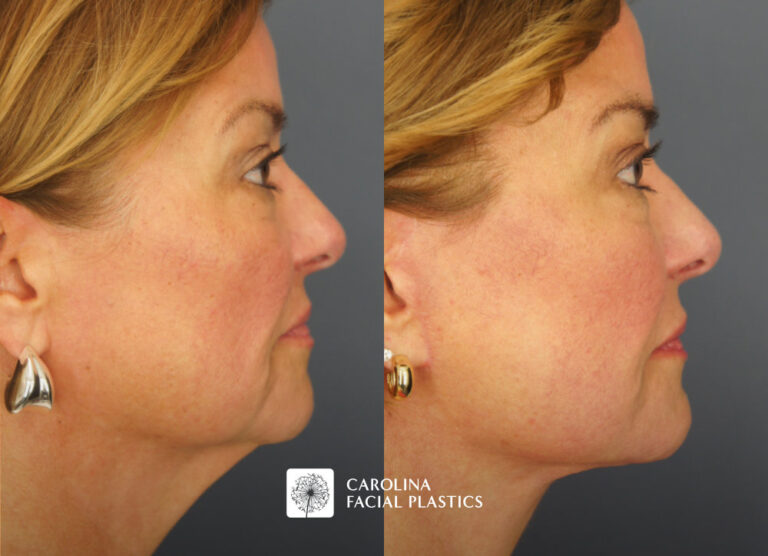 before and after facelift in charlotte