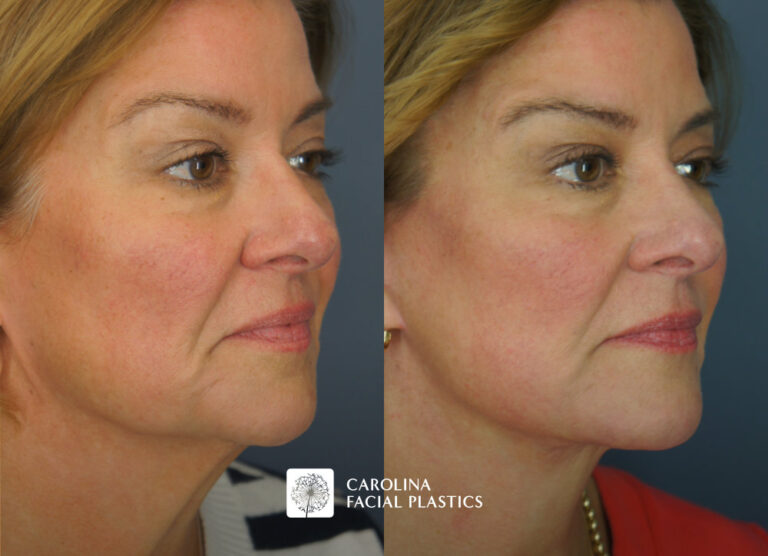 facelift surgery before and after